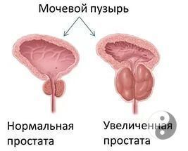 простата